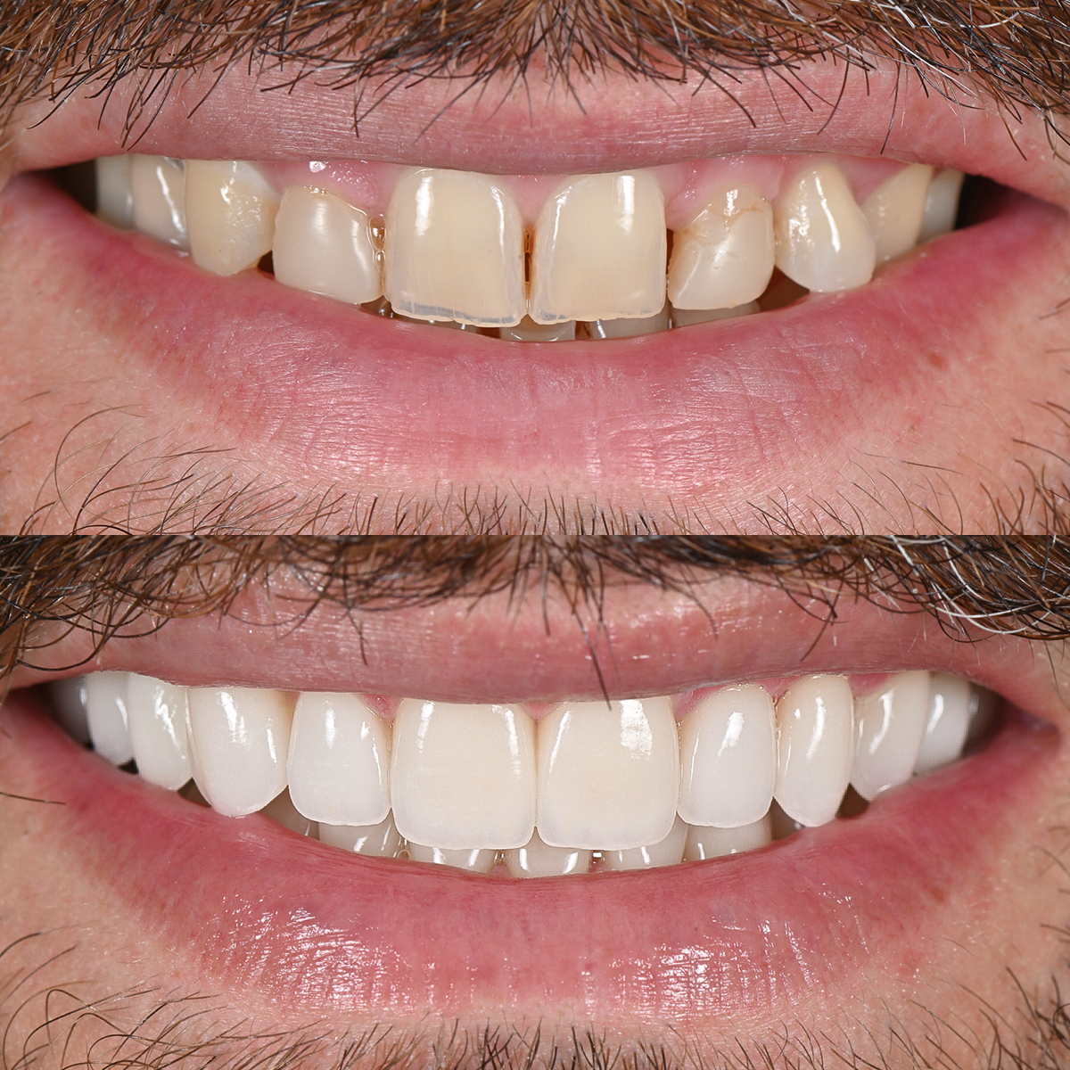 Detalhe de sorriso esculpido